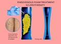 Endovenous laser treatment for varicose veins - foam sclerotherap concept. Royalty Free Stock Photo
