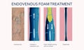 Endovenous laser treatment for varicose veins - foam sclerotherapy concept. Royalty Free Stock Photo