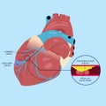 Illustration of Artery with cholesterol buildup, Cholesterol plaque buildup, blood clot blocked Royalty Free Stock Photo