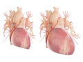 An enlarged heart Royalty Free Stock Photo