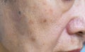 Enlarged pores in face of Asian, elder man with skin folds