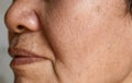 Enlarged pores in face of Asian, elder man with skin folds