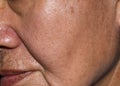 Enlarged pores in oily face of Asian, elder man with skin folds