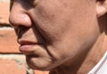 Enlarged pores in oily face of Asian, elder man with skin folds