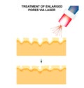 Enlarged pores. The structure of the skin. Wrinkles, acne scar. The narrowing of the pores by a laser. Infographics Royalty Free Stock Photo