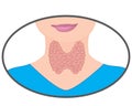 Enlarged Thyroid. Endocrine disfunction vector illustration on a white background Royalty Free Stock Photo