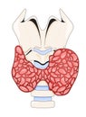 Enlarged thyroid gland affected by hyperthyroidism 2D vector illustration Royalty Free Stock Photo