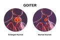 Enlarged thyroid gland, 3D illustration