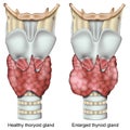 Enlarged thyroid gland 3d medical illustration isolated on white background