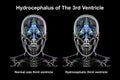 Enlargement of the third brain ventricle, 3D illustration