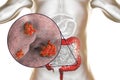 Entamoeba histolytica protozoan infection of large intestine