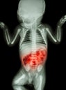 Enteritis (X-ray of sick infant and inflammation of intestine) Royalty Free Stock Photo