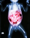 Enteritis (X-ray of sick infant and inflammation of intestine) Royalty Free Stock Photo