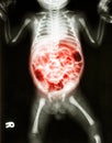 Enteritis (X-ray of sick infant and inflammation of intestine) Royalty Free Stock Photo