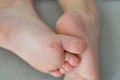 Enterovirus foot hand mouth Skin peeled off on the body of a child Cocksackie virus Royalty Free Stock Photo