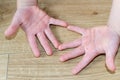 Enterovirus Hand Rash on the body of a child. Cocksackie virus rash beginning, initial stage, spots on the hands