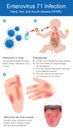 Enterovirus 71 Infection.Hand, foot, and mouth disease.