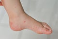 Enterovirus Leg arm mouth Rash on the body of a child Cocksackie virus Royalty Free Stock Photo