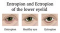 Entropion and Ectropion of the lower eyelid Royalty Free Stock Photo