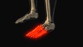 Medical animation of the metatarsal and phalanges bone pain