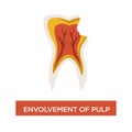 Envolvement of pulp dental disease mouth cavity dentistry