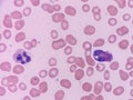 Eosinophil and neutrophil seen on peripheral blood smear