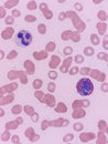 Eosinophil and neutrophil seen on peripheral blood smear