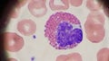 Eosinophil and red blood cells on peripheral blood smear