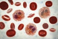 Eosinophilia, blood smear showing multiple eosinophils surround by red blood cells