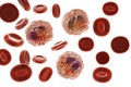 Eosinophilia, blood smear showing multiple eosinophils surround by red blood cells