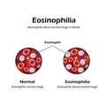 Eosinophils above normal range in blood. Eosinophilia. Infographics. Vector illustration
