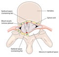 Epidural abscess Royalty Free Stock Photo