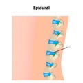 Epidural anesthesia during childbirth. Epidural anesthesia of pregnant women. Vector illustration.