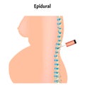 Epidural anesthesia during childbirth. Epidural anesthesia of pregnant women. Vector illustration.