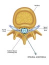 Epidural anesthesia diagram Royalty Free Stock Photo