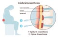 Epidural and spinal anesthesia. Labor anesthesia of pregnant woman