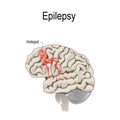 Human brain with hotspot hotspot of epilepsy Royalty Free Stock Photo