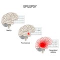 Epilepsy. EEG of healthy brain and epileptic seizure.