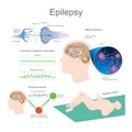 Epilepsy