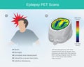 Epilepsy PET scans. Royalty Free Stock Photo