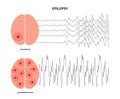 epilepsy seizure concept