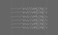 Epileptic seizure brainwaves on black background