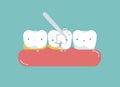 Equipment of dental is cleaning tooth for good healthy