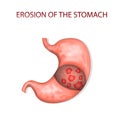 Erosion of the stomach