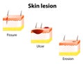 Erosion, Ulcer and Fissure