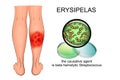 Erysipelas of the lower leg