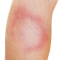 Erythema Migrans rash. Royalty Free Stock Photo