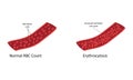 Erythrocytosis vector illustration Royalty Free Stock Photo