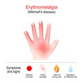 Erythromelalgia. Mitchell`s disease in left hand. Symptoms and signs of Erythromelalgia