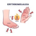 Erythromelalgia syndrome caused redness, pain and warmth outline diagram